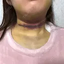 脂肪吸引（顔） TCB東京中央美容外科 新横浜院 AFTER サムネイル用