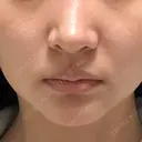 RF（高周波）たるみ治療 あいちビューティークリニック DAY 6 サムネイル用