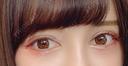 二重切開 / 眼瞼下垂（切開） / 目尻切開 / タレ目形成・グラマラスライン（切開） / ヒアルロン酸注入（涙袋） ジュエリー美容外科 DAY 10 サムネイル用