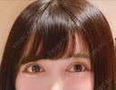 二重切開 / 眼瞼下垂（切開） / 目尻切開 / タレ目形成・グラマラスライン（切開） / ヒアルロン酸注入（涙袋） ジュエリー美容外科 DAY 12 サムネイル用