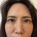 クマ治療 湘南美容クリニック 西葛西院 AFTER サムネイル用