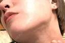 糸リフト / 脂肪吸引（顔） Wing clinic 豊中駅前院 DAY 22 サムネイル用