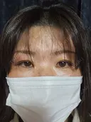 二重埋没 湘南美容クリニック 千葉センシティ院 DAY 3 サムネイル用