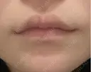 口角挙上 LOUIS CLINIC 二子玉川院【ルイクリニック】 DAY 26 サムネイル用