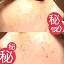 ルメッカ MIO CLINIC 梅田院 DAY 7 サムネイル用