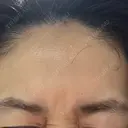 ボトックス（眉間） ちぐさ内科クリニック 覚王山 DAY 5 サムネイル用