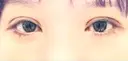 二重埋没 / 上まぶたの脂肪取り / ボトックス（額） 9BeautyClinic DAY 8 サムネイル用