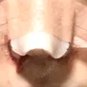 鼻尖形成（切開） / 小鼻縮小（切開） / 眉間プロテーゼ 東京シンデレラ美容外科 池袋院 DAY 1 サムネイル用