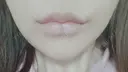 ヒアルロン酸注入（唇） ライアン美容外科 AFTER サムネイル用