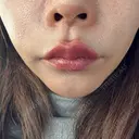 ヒアルロン酸注入（鼻翼基部） ルラ美容クリニック 大宮院 / ルラスキンクリニック 大宮院 AFTER サムネイル用