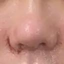 鼻尖形成（切開） / 小鼻縮小（切開） / 眉間プロテーゼ 東京シンデレラ美容外科 池袋院 DAY 7 サムネイル用