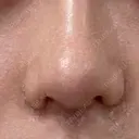 鼻尖形成（切開） / 小鼻縮小（切開） / 眉間プロテーゼ 東京シンデレラ美容外科 池袋院 AFTER サムネイル用