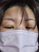 二重埋没 湘南美容クリニック 千葉センシティ院 DAY 4 サムネイル用