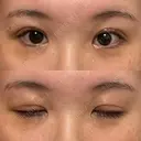 二重切開 / 眼瞼下垂（切開） / 上まぶたたるみ取り ユア美容クリニック 福岡院 DAY 7 サムネイル用