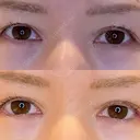 目尻切開 / タレ目形成・グラマラスライン（埋没） LOUIS CLINIC 二子玉川院【ルイクリニック】 DAY 7 サムネイル用