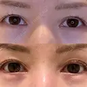 目尻切開 / タレ目形成・グラマラスライン（埋没） LOUIS CLINIC 二子玉川院【ルイクリニック】 DAY 9 サムネイル用