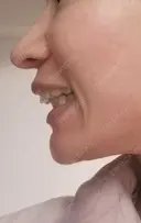 矯正（マウスピース） 銀座青山You矯正歯科 池袋西口医院 DAY 324 サムネイル用