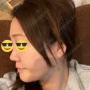 鼻尖形成（切開） / その他（鼻） / 眉間プロテーゼ / ヒアルロン酸注入（涙袋） YBC横浜美容外科 立川院 DAY 15 サムネイル用
