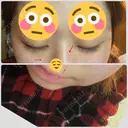 シミ取りレーザー / YAGレーザー 新宿Sクリニック AFTER サムネイル用