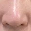 鼻尖形成（切開） / 軟骨移植 / 鼻孔縁下降 / 鼻柱下降・鼻唇角形成（猫手術） もとび美容外科クリニック 新宿院 AFTER サムネイル用