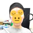 RF（高周波）たるみ治療 MEMOTO CLINIC 名古屋 DAY 4 サムネイル用