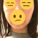 RF（高周波）たるみ治療 MEMOTO CLINIC 名古屋 DAY 7 サムネイル用
