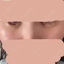 ヒアルロン酸注入（涙袋） / ヒアルロン酸注入（唇） PRO CLINIC プロクリニック 銀座院 DAY 7 サムネイル用