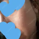 リジュラン ミニマムスキンクリニック池袋 DAY 8 サムネイル用