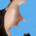 リジュラン ミニマムスキンクリニック池袋 DAY 8 サムネイル用