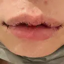 口角挙上 / その他（口元） アネシス美容クリニック DAY 0 サムネイル用