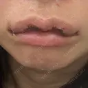 口角挙上 / その他（口元） アネシス美容クリニック DAY 1 サムネイル用