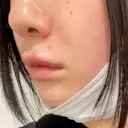 ヒアルロン酸注入（唇） / ボトックス（口角） ルラ美容クリニック 高田馬場院 AFTER サムネイル用