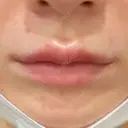 ヒアルロン酸注入（唇） / ボトックス（口角） ルラ美容クリニック 高田馬場院 DAY 4 サムネイル用