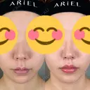 鼻尖形成（切開） / 人中短縮 / 鼻孔縁挙上 / その他（鼻） アリエル美容クリニック 大宮院 DAY 94 サムネイル用