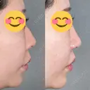 鼻尖形成（切開） / 人中短縮 / 鼻孔縁挙上 / その他（鼻） アリエル美容クリニック 大宮院 DAY 94 サムネイル用