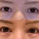 目尻切開 / タレ目形成・グラマラスライン（埋没） LOUIS CLINIC 二子玉川院【ルイクリニック】 DAY 10 サムネイル用