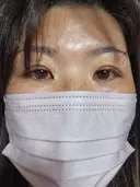 二重埋没 湘南美容クリニック 千葉センシティ院 DAY 5 サムネイル用