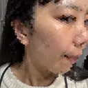 ほくろ・いぼ切除（肌） KARIS beauty clinic DAY 16 サムネイル用