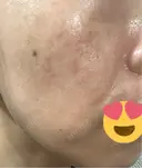 ルメッカ ルラ美容クリニック 札幌本院 AFTER サムネイル用