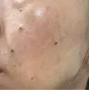 ルメッカ ルラ美容クリニック 札幌本院 DAY 3 サムネイル用