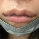 口角挙上 / その他（口元） アネシス美容クリニック DAY 2 サムネイル用