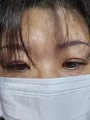 二重埋没 湘南美容クリニック 千葉センシティ院 DAY 6 サムネイル用