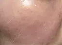 ピコレーザートーニング（美白・かんぱん） / ピコフラクショナルレーザー（毛穴・ニキビ跡） サクラアズクリニック 心斎橋院 AFTER サムネイル用