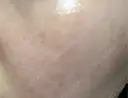 ピコレーザートーニング（美白・かんぱん） / ピコフラクショナルレーザー（毛穴・ニキビ跡） サクラアズクリニック 心斎橋院 DAY 10 サムネイル用