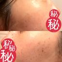 ルメッカ MIO CLINIC 梅田院 DAY 10 サムネイル用