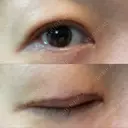 二重切開 / 上まぶたたるみ取り / 上まぶたの脂肪取り VIDA BEAUTY CLINIC DAY 5 サムネイル用