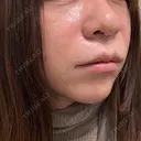 隆鼻術 / 鼻中隔延長（切開） / その他（鼻） / 軟骨移植 / ワシ鼻修正・ハンプ切除 / 鼻尖縮小 / 鼻翼基部形成（貴族手術） 4Dクリニック DAY 5 サムネイル用