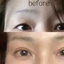 眉下切開 湘南美容クリニック 秋葉原院 DAY 1761 サムネイル用