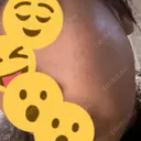 リジュラン ミニマムスキンクリニック池袋 DAY 9 サムネイル用