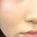 ポテンツァ 上野美容外科・美容皮膚科 DAY 1 サムネイル用